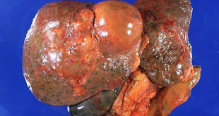 Καρκίνος ήπατος (συκώτι). Σε τι οφείλεται, ποια τα συμπτώματα και ποια η θεραπεία; Υπάρχει πρόληψη;