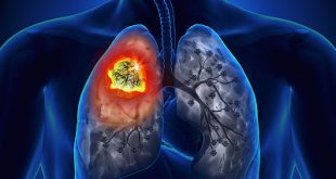Καρκίνος του πνεύμονα: νέα θεραπεία δίνει ελπίδα σε ασθενείς