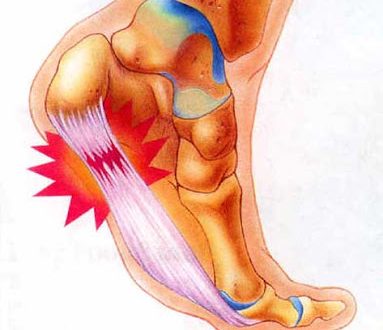 Πόνος στη φτέρνα, πελματιαία απονεύρωση, άκανθα πτέρνας. Θεραπεία και ασκήσεις για το σπίτι