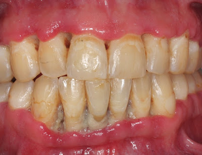 Έντονη κακοσμία, μεταλλική γεύση μπορεί να οφείλονται σε οξεία ελκονεκρωτική ουλίτιδα