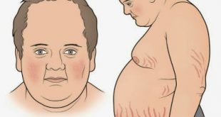 Αύξηση βάρους, διαβήτης, υπέρταση και εύκολη κόπωση μπορεί να συνδέονται με νόσο, σύνδρομο Cushing