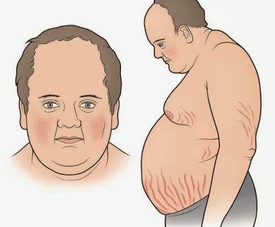 Αύξηση βάρους, διαβήτης, υπέρταση και εύκολη κόπωση μπορεί να συνδέονται με νόσο, σύνδρομο Cushing