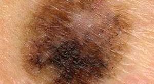 Κακοήθεις όγκοι του δέρματος. Χαρακτηριστικά που έχουν οι ελιές, που μας προειδοποιούν για πιθανό καρκίνο