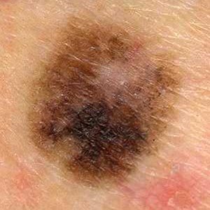Κακοήθεις όγκοι του δέρματος. Χαρακτηριστικά που έχουν οι ελιές, που μας προειδοποιούν για πιθανό καρκίνο