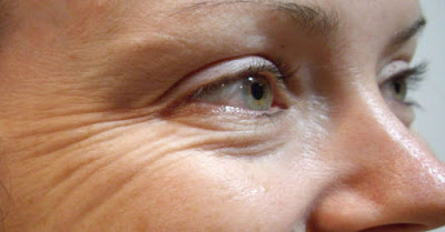 Ρυτίδες. Αιτίες που τις προκαλούν. Οδηγίες πρόληψης και τρόποι αντιμετώπισης