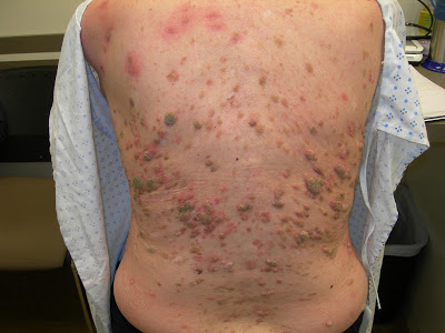 Τι είναι η σμηγματορροϊκή υπερκεράτωση, που μπορεί να έχετε στο δέρμα σας; Πόσο επικίνδυνη είναι και πώς αφαιρείται;