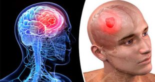 Ζάλη, πονοκέφαλος, ναυτία, αστάθεια, σπασμοί μπορεί να οφείλονται σε όγκο - καρκίνο στον εγκέφαλο. Παράγοντες κινδύνου