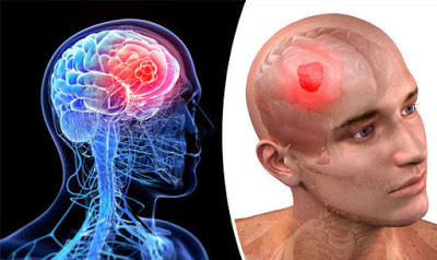Ζάλη, πονοκέφαλος, ναυτία, αστάθεια, σπασμοί μπορεί να οφείλονται σε όγκο - καρκίνο στον εγκέφαλο. Παράγοντες κινδύνου