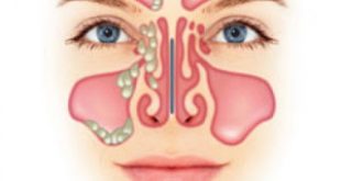 Επέμβαση ιγμόρειων άντρων με καθοδήγηση navigator στον ΑΓ. Σάββα