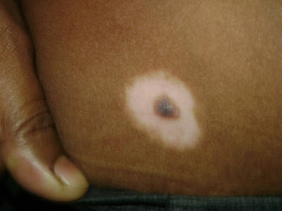 Τι είναι η ελιά που περιβάλλεται από λευκή στεφάνη; Σπίλος Sutton ή Halo. Έχει σχέση με λεύκη;