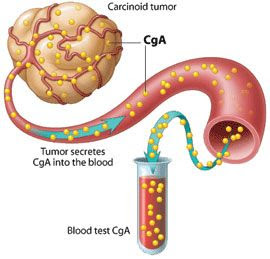 Xρωμογρανίνη, ειδική εξέταση για καρκίνους του ενδοκρινικού και νευρικού συστήματος, του προστάτη και του πνεύμονος