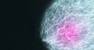 Ακόμη και οι μικροί όγκοι του μαστού μπορεί να είναι επιθετικοί