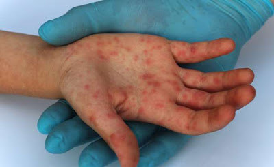 Με ιλαρά διαγνώστηκαν έξι γιατροί δημόσιων νοσοκομείων