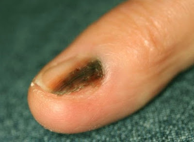 Μελάνωμα στο νύχι, στις άκρες των δακτύλων. Σκούρες γραμμές στα νύχια μπορεί να οφείλονται σε αιμάτωμα ή καρκίνο;