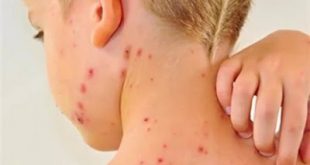 Ο ΥΥ Ανδρέας Ξανθός για την επιδημική έξαρσης της ιλαράς. Στην Επιτροπή Κοινωνικών Υποθέσεων της βουλής το θέμα.