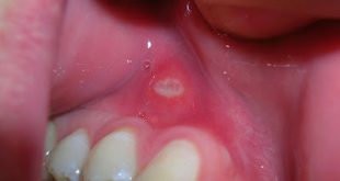Στοματικό απόστημα: Μια δυσάρεστη διόγκωση στο στόμα ή και στο πρόσωπο