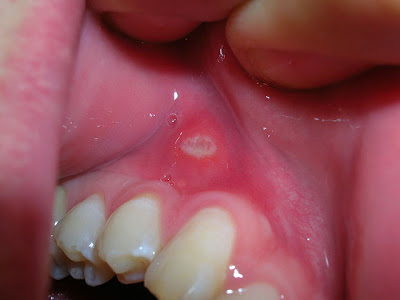 Στοματικό απόστημα: Μια δυσάρεστη διόγκωση στο στόμα ή και στο πρόσωπο