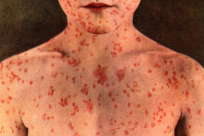 Τι είναι η ιλαρά; Ποια τα συμπτώματα, ποιοι θεωρούνται ασφαλείς και ποιοι πρέπει να εμβολιαστούν;
