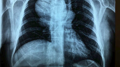 Το μεγαλύτερο παγκοσμίως ανεύρυσμα υποκλείδιας αρτηρίας αντιμετωπίστηκε επιτυχώς στο Διαβαλκανικό