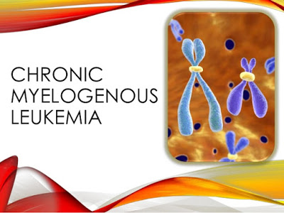 Χρόνια Μυελογενής Λευχαιμία (ΧΜΛ). Αιματολογική κακοήθεια που εμφανίζεται κυρίως στους ενήλικες