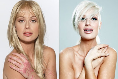 Η ψωρίαση δεν είναι μεταδοτική και δεν δημιουργεί προβλήματα σε τρίτους