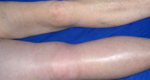 Πώς προλαμβάνεται η εν τω βάθει φλεβική θρόμβωση; Που οφείλεται και ποια τα συμπτώματά της;