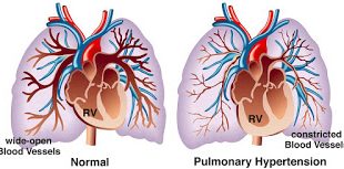 Ελπίδες για νέο φάρμακο κατά της πνευμονικής αρτηριακής υπέρτασης