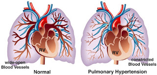 Ελπίδες για νέο φάρμακο κατά της πνευμονικής αρτηριακής υπέρτασης