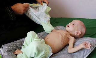 Λιμοκτονούν χιλιάδες παιδιά στην Υεμένη