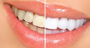 Ο Οδοντιατρικός Συλλόγος Πειραιώς για το λουκέτο που μπήκε σε επιχείρηση που πραγματοποιούσε παράνομα λευκάνσεις δοντιών