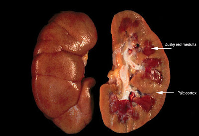 Τι είναι η οξεία νεφρική βλάβη και ποιοι παράγοντες την προκαλούν;