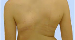 Τι είναι η σκολίωση, ποιες αιτίες την προκαλούν, πότε και πώς πρέπει να αντιμετωπίζεται;