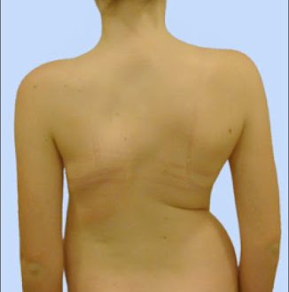 Τι είναι η σκολίωση, ποιες αιτίες την προκαλούν, πότε και πώς πρέπει να αντιμετωπίζεται;