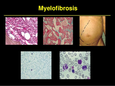 H Novartis παρουσιάζει τη νέα mobile εφαρμογή “MPN Assistant GR”, για ασθενείς με μυελοΐνωση και αληθή πολυκυτταραιμία