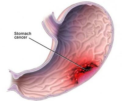Καρκίνος του στομάχου. Ποια τα συμπτώματα και ποια τα μέτρα πρόληψης; Ποιες τροφές βοηθούν και τι προσέχουμε;