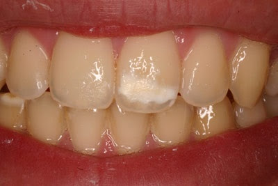 Κηλίδες καφέ, λευκές, υποκίτρινες στα δόντια (Υπενασβεστίωση – Υποπλασία της αδαμαντίνης)