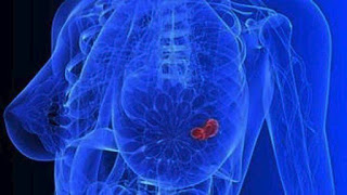 Έρευνα Η ασπαραγίνη, σε πολλά τρόφιμα, ευνοεί την εξάπλωση του καρκίνου του μαστού