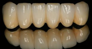 Τι είναι η οδοντιατρική γέφυρα και τι πρέπει να προσέχουμε;