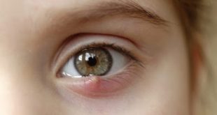 Τι είναι το χαλάζιο στο μάτι και σε τι διαφέρει από το κριθαράκι; Τι χρειάζεται να γίνει για να προληφθεί η υποτροπή;