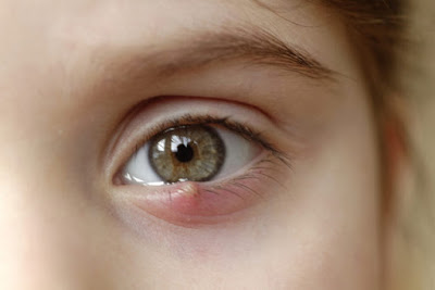 Τι είναι το χαλάζιο στο μάτι και σε τι διαφέρει από το κριθαράκι; Τι χρειάζεται να γίνει για να προληφθεί η υποτροπή;