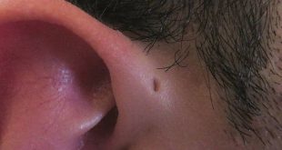 Αν έχετε αυτές τις μικρές τρυπίτσες γύρω από τα αυτιά… κανένας λόγος ανησυχίας
