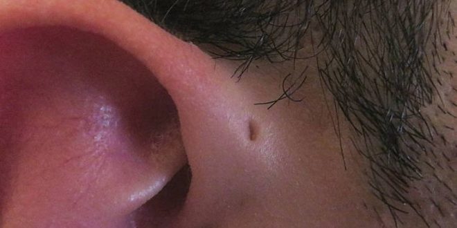 Αν έχετε αυτές τις μικρές τρυπίτσες γύρω από τα αυτιά… κανένας λόγος ανησυχίας