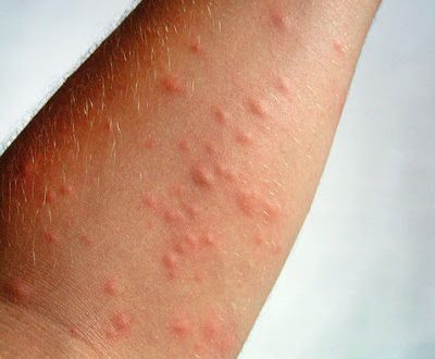 Δερματίτιδα από κάμπιες, με φαγούρα, κοκκινίλες, εξάνθημα. Τι να κάνετε και τι πρέπει να προσέξετε;