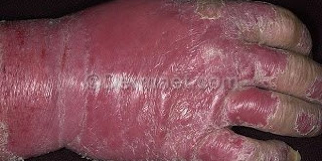 H πρώτη παγκόσμια Έκθεση για τον δείκτη Ευτυχίας των ανθρώπων με ψωρίαση και η ανάγκη ευαισθητοποίησης και ενημέρωσης