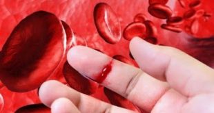 Αιμορροφιλία, τι είναι, τι προκαλεί και πώς αντιμετωπίζεται; Πρώτες βοήθειες αιμορραγικού επεισοδίου