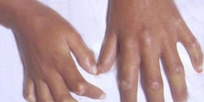 Συστηματικό σκληρόδερμα. Μια σπάνια ρευματολογική νόσος με σοβαρές καρδιολογικές συνέπειες (20 Απριλίου Ωνάσειο)