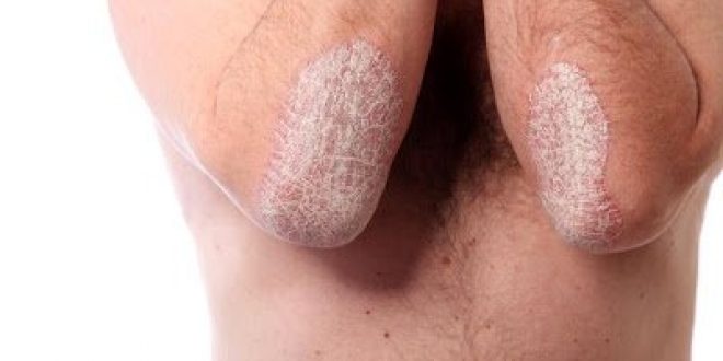 Η σεκουκινουμάμπη (Novartis), βελτίωσε την ποιότητα ζωής ασθενών με μέτρια έως σοβαρή ψωρίαση κατά πλάκας