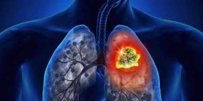 Νέα δεδομένα αλλάζουν το «τοπίο» στην αντιμετώπιση του καρκίνου του πνεύμονα