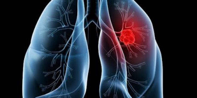 Ο συνδυασμός του nivolumab με χαμηλή δόση ipilimumab μειώνει τον κίνδυνο εξέλιξης της νόσου ή θανάτου σε ασθενείς με καρκίνο του πνεύμονα