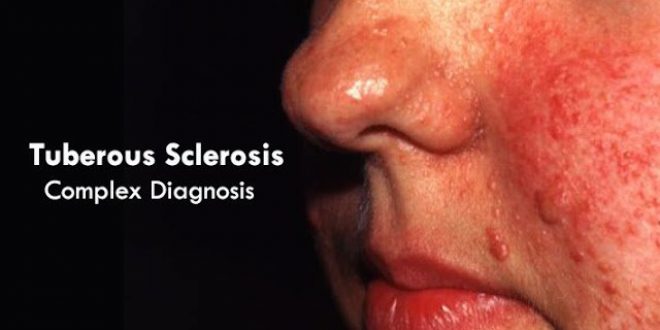 Οζώδης σκλήρυνση, μια σπάνια αλλά σοβαρή πάθηση. 15η Μαΐου Παγκόσμια Ημέρα